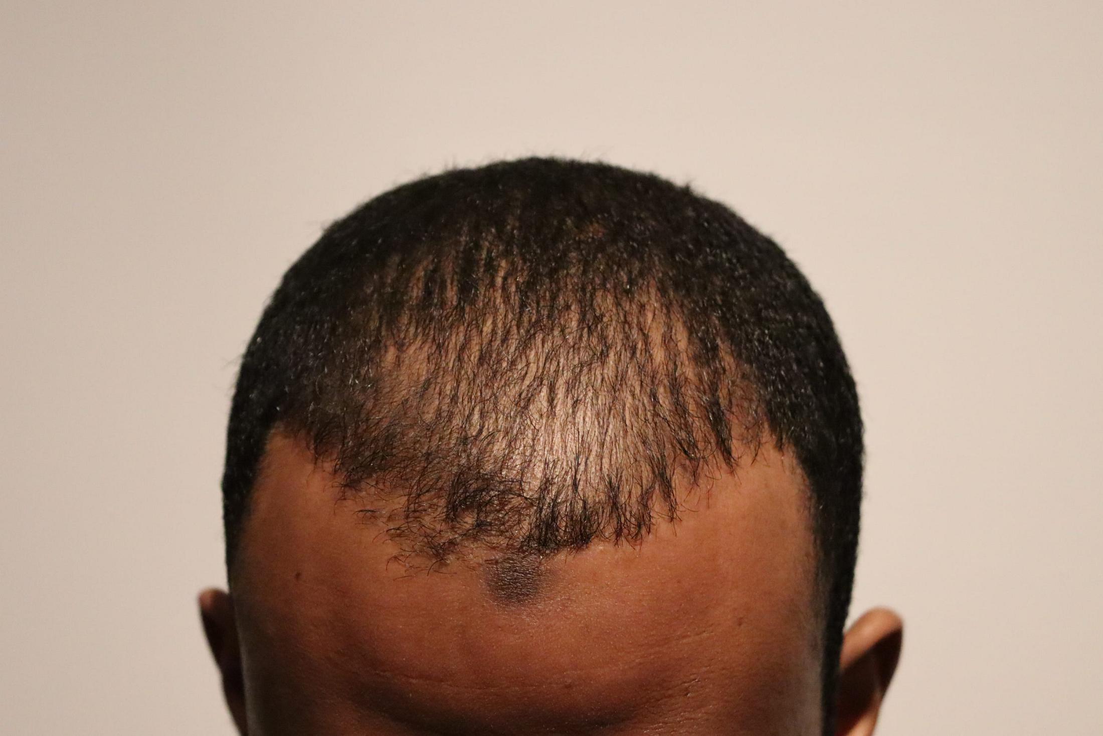 Ethnic Hair Transplant Before & After Image